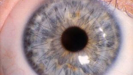 Closeup of an Eye That Has Had the Corneal Cross-Linking Procedure Done