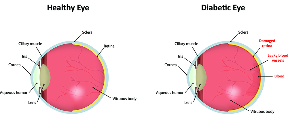 Chart Illustrating a Healthy Eye Compared to One With Diabetic Retinopathy