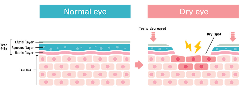Chart Showing the 3 Layers of the Tear Film in the Eye and Comparing a Normal Eye to One Experiencing Dry Eye