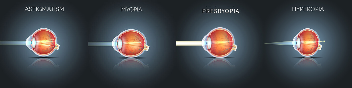 Chart Showing How Astigmatism, Myopia, Presbyopia and Hyperopia Affect an Eye