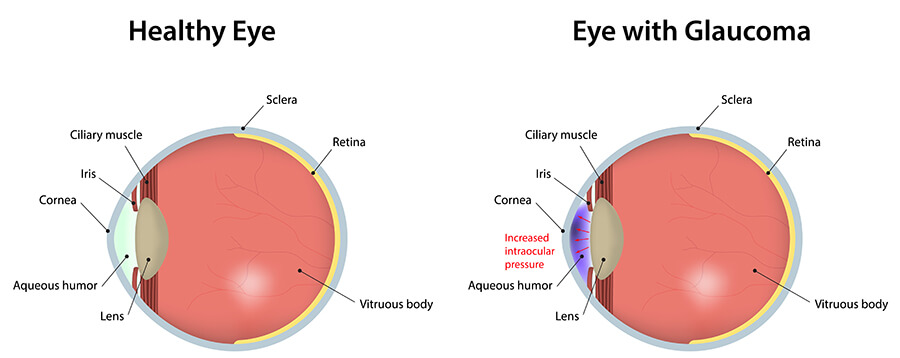 Chart Illustrating a Healthy Eye Compared to One With Glaucoma