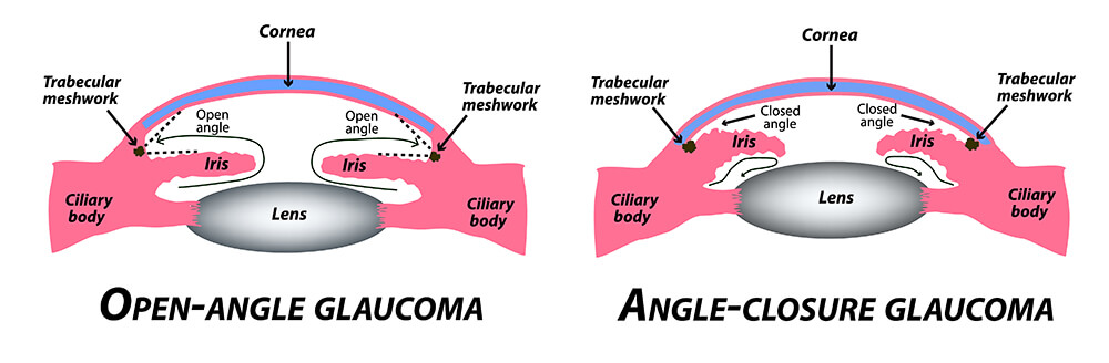Diagram Illustrating How Open-Angle and Angle-Closure Glaucoma Affects the Eye