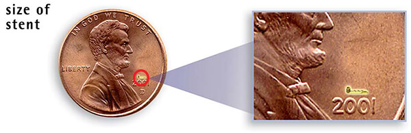 Showing an iStent on top of a Penny, Letting You Know How Small it Is