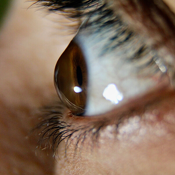 Closeup of an Eye With Keratoconus