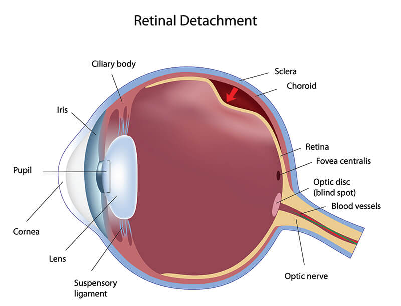 Chart Showing How a Retinal Detachment Affects an Eye
