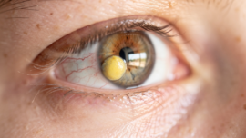 understand-pinguecula-en-el-ojo-symptoms-treatments-and-prevention