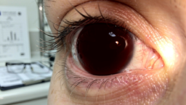 understanding-8-ball-hyphema-symptoms-treatments-and-risks