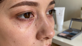 understanding-allergic-reactions-on-eyelids-symptoms-and-treatments