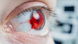 understanding-eye-bleed-causes-symptoms-and-treatments-explained