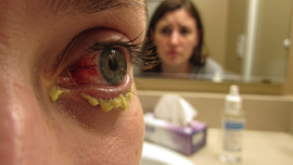 understanding-mucopurulent-conjunctivitis-symptoms-and-treatments