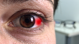 what-does-blood-in-the-eye-mean-causes-symptoms-and-risks